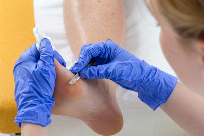 Pédicure-podologue enlevant les durillons d'un pied